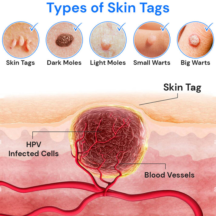 Wart-Remover™ 20ml